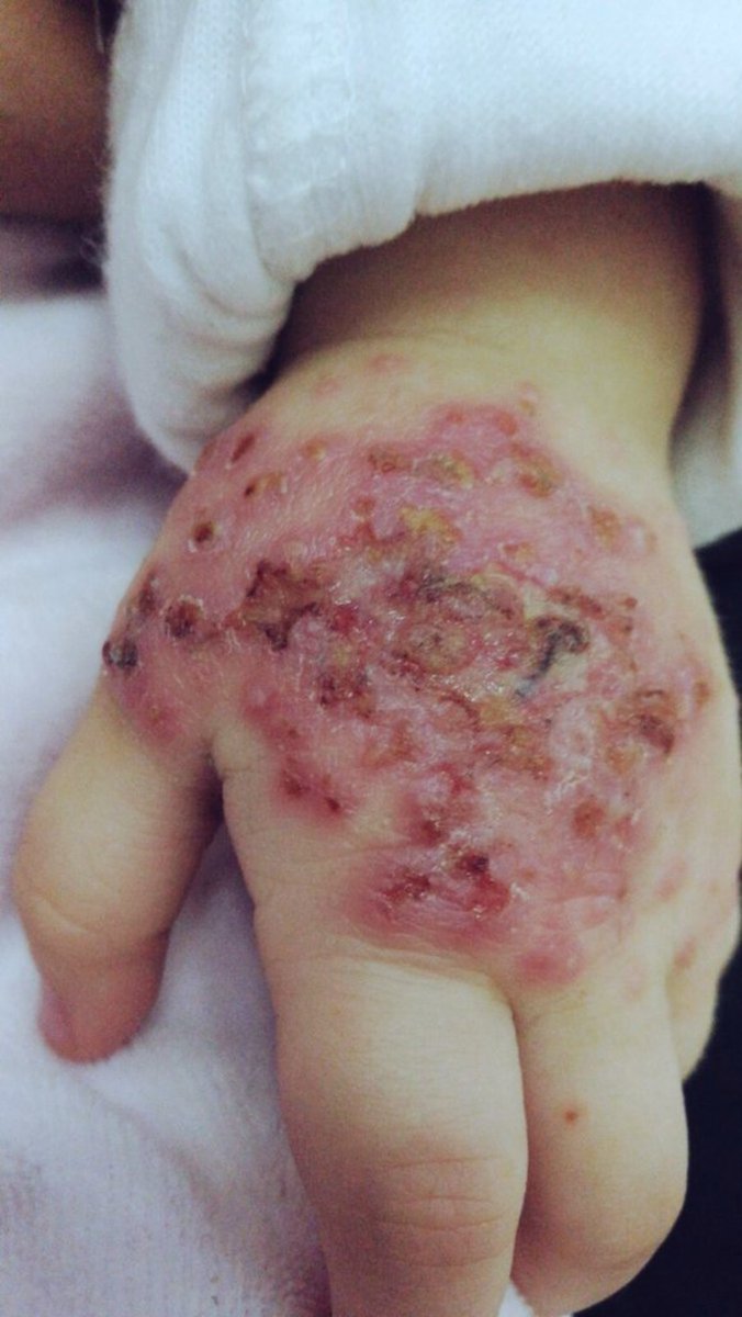 yousefQasem1998's tweet photo. I NEED TREATMENT 😭 

︎
︎

︎

︎

︎

︎
︎

︎

︎

︎

︎i’ll remind u🥹
︎

︎

︎

︎

︎

︎

︎
︎

︎

︎
︎

︎
︎

︎
︎

︎

︎

︎

︎

︎

I NEED TREATMENT ⭐️✨️

Scabies has spread all over my child's body I am worried about my baby girl😭
https://t.co/45Gj0rpJam https://t.co/r6ReOiSfAT