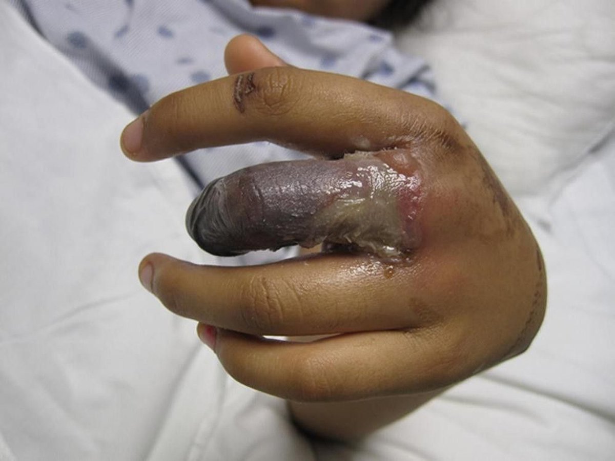 markywarner's tweet photo. @Sniper64286433 These are pictures of third degree burns! I don’t think those burn you showed are third degree burns! Your stupidity is astounding! https://t.co/mnwEiuvTSr