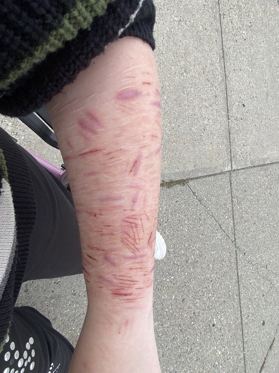 Psychobixch2's tweet photo. Fake body SFX makeup ai generated healed scars
I think I’m tanning a little bit
#sh #shedtwt #slittwt #babybeans #beanstwt #988twt #selfharm https://t.co/EXDZdxzp0V