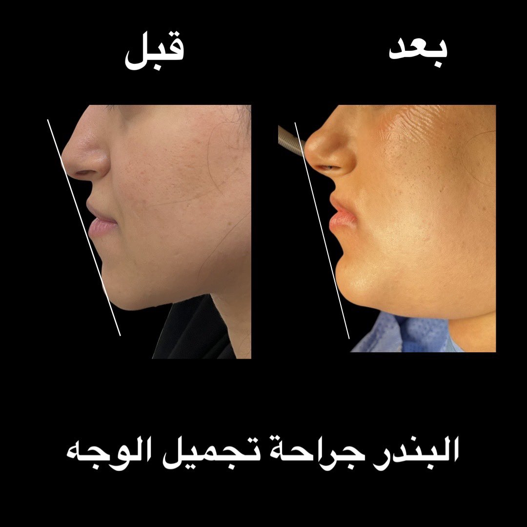 ALBANDAR_OMFS's tweet photo. عملية تقديم الذقن https://t.co/aSFCR8zNJZ