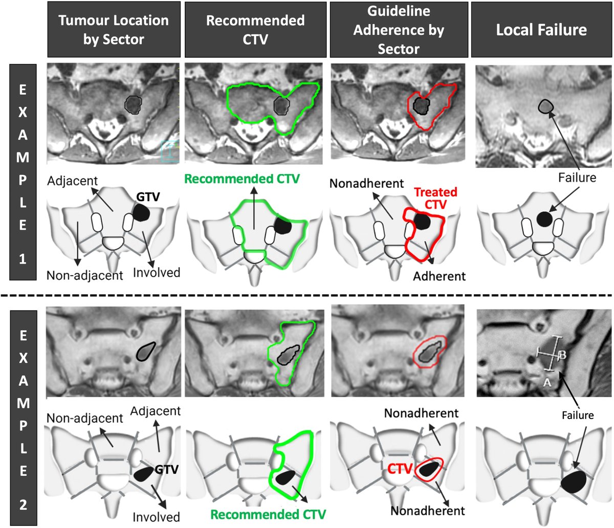 ASTRO_org's tweet photo. New in #practicalRO: Impact of Adherence to Target Volume Contouring Guidelines on Patterns of Failure in Sacral Stereotactic Body Radiotherapy. #radonc https://t.co/prkSUPDwa0 https://t.co/7Bi0wnMOqi