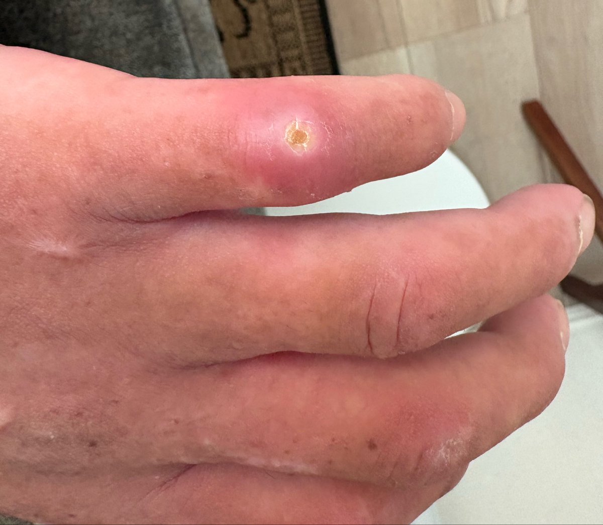 hch8r's tweet photo. 閲覧注意⚠️
全身強皮症
小指の潰瘍がひどく、中が外でむき出しです。
もう指は固まって全く動きません
全身皮膚炎症の痛みは、擦り傷に塩を塗るような、日焼けで熱い風呂に入るような痛みと先物で日々寝不足です
今日も弱音吐きましたが
来週は肺年齢検査するので、全力アピールしてお薬もらうんだ🥹 https://t.co/GDP9mkkXsj