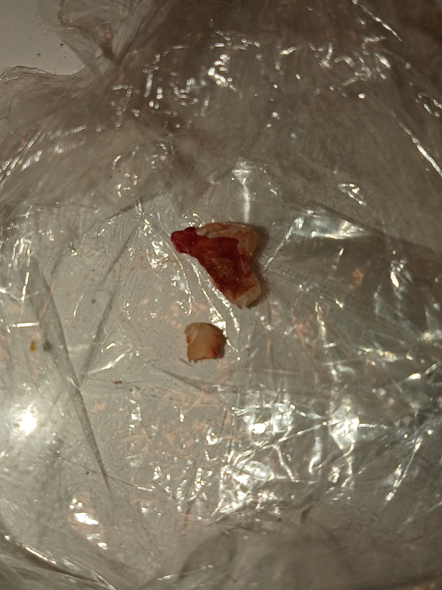 NoSayqnsz's tweet photo. Just pulled my tooth out my mouth. It was cracked badly and the pain was irritating. https://t.co/zURQZBCIW0