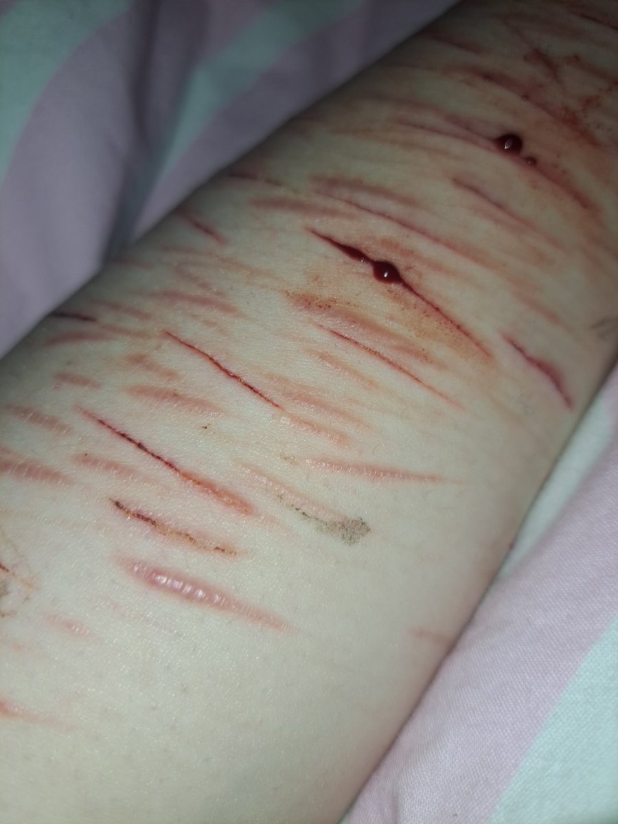 doll_dowfallx's tweet photo. Somebody called me scarspo my life if yours now
#shtwt #scarspo https://t.co/nEwplKy3p3
