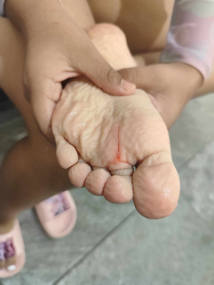 ContraProMx's tweet photo. #DENUNCIACIUDADANA 

*¡DE MÁS A MENOS! EXIGIMOS SANIDAD Y DIGNIDAD EN LA VILLA OLÍMPICA*

A la opinión pública:

Al Gobernador del Estado de #Oaxaca, Ing. @salomonj Jara Cruz

A las autoridades de Salud y Protección Civil del Estado

A la directiva del Colegio Euroamericano

Por medio de la presente, los usuarios de la #VillaOlímpica (complejo que legalmente pertenece a todos los oaxaqueños) manifestamos nuestro total rechazo, indignación y preocupación ante el estado de abandono, insalubridad y negligencia con el que opera la actual administración a cargo del Colegio Euroamericano. Lo que debió ser un espacio de salud y desarrollo, hoy representa un foco de infección y un peligro inminente para niños, jóvenes y adultos.

Denunciamos de manera enérgica los siguientes hechos que atentan directamente contra nuestra integridad física:

_Ataque directo a la salud infantil por negligencia química:_

Hace un par de semanas, la administración aplicó químicos de alta toxicidad a la alberca en pleno horario de clases de los infantes. Esto provocó crisis respiratorias, tos severa, ardor en la garganta, irritación extrema, ojos rojos y sarpullido en la piel de los alumnos. Muchos tuvieron que abandonar la clase y requirieron atención médica. ¿La respuesta de la administración? El silencio absoluto y la inacción.

_Instalaciones deplorables y riesgo de cortes:_

La alberca chica presenta desprendimiento de losetas en su estructura. Esto ya ha ocasionado heridas y cortes en la piel tanto de niños como de adultos, sin que se proceda a su reparación.

_Falsa publicidad y agua congelada:_

 Presumen un "sistema sofisticado de calefacción" que en la realidad no funciona. El agua permanece helada, obligando a los alumnos a salir de la piscina con los labios morados y desencadenando constantes enfermedades en las vías respiratorias debido a los cambios bruscos de temperatura.

_Colapso de servicios básicos y sanitarios:_
 El área de cambiadores sufre un desabasto crónico de agua. El servicio de regaderas está severamente limitado, se alternan los días y la mayoría de las duchas no sirven.

_Alerta sanitaria por agua descompuesta:_
 El pasado 19 de agosto, el agua de toda la instalación —tanto de los sanitarios como de la propia alberca— comenzó a despedir un fuerte olor a podrido y descomposición. La queja fue presentada de inmediato y la administración decidió ignorarla, obligando a los usuarios a retirarse a sus hogares impregnados de este olor pestilente y nocivo.

Es inaceptable que un complejo deportivo reciente, por el cual los ciudadanos pagamos puntualmente una mensualidad, se encuentre en la quiebra operativa. 

En administraciones pasadas, el gimnasio, el sauna, la alberca con hidromasaje, los sanitarios y las regaderas funcionaban a la perfección. Hoy, la incompetencia del Colegio Euroamericano está ahuyentando a la población de la vida saludable y violentando los derechos de quienes no tienen otra alternativa médica o deportiva.

¡YA BASTA! Exigimos formalmente al Gobernador Salomón Jara Cruz que intervenga de inmediato. Esto ya no es solo una queja por un mal servicio; es un problema de salud pública y protección civil.

Exhortamos firmemente al Colegio Euroamericano a dar la cara, asumir su responsabilidad y resolver de inmediato cada una de las deficiencias denunciadas antes de que ocurra una tragedia mayor. 

¡Las instalaciones son de los oaxaqueños y exigimos un trato digno!

Atentamente,
Usuarios de la Villa Olímpica