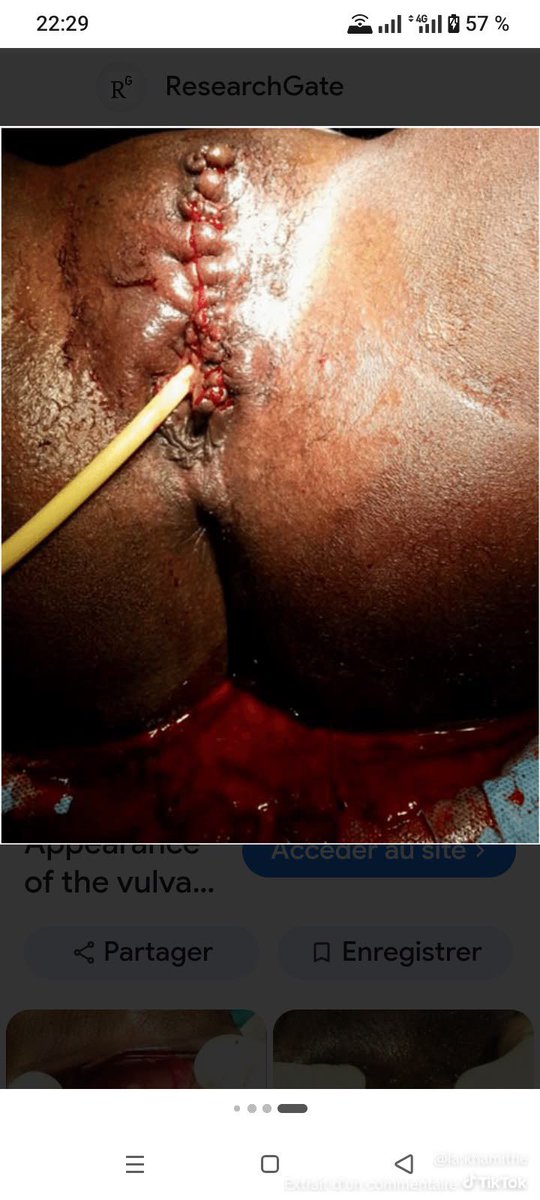 Madame_Ulrich's tweet photo. Images choquantes
Puisqu’une image vaut mille mots , nous vous présentons jusqu’où la misogynie des hommes africains peut aller.
Sans anesthésie , de façon archaïque et traditionnelle des millions de femmes continuent de subir, souffrir et de mourir !
#StopExcision #AbaslesMGF https://t.co/VOQBcNnZVV