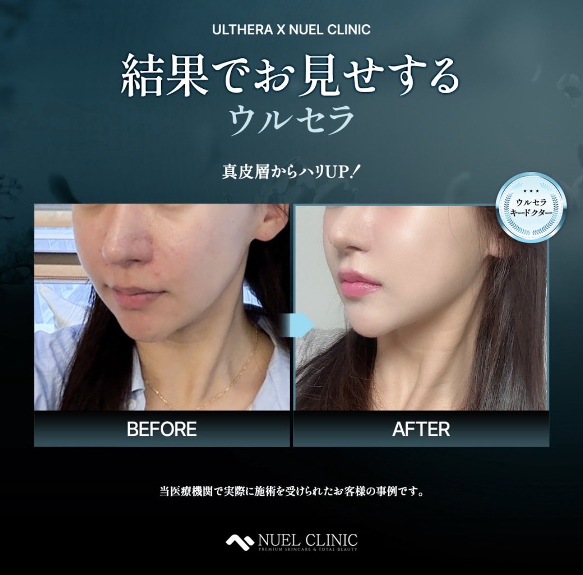 NuelClinic's tweet photo. 「ウルセラ受けたけどイマイチだった…」
それ、機械のせいじゃないかも🫥🫥🫥
実はウルセラは、【誰が打つか】で効果も持ちも全く変わります！
「同じ機械ならどこで受けても一緒」と思われがちですが、実はドクターの技術差が出やすい施術なんです。その理由がこちら👇
✅脂肪のつき方と「筋膜（SMAS層）」の深さを見極める力
⇨皮膚の厚みや骨格は一人ひとり違います。超音波画像で狙った層（4.5mm/3.0mm/1.5mm）にピンポイントで照射できるかが勝負！
✅照射の「角度」と「密着度」
⇨皮膚に対して正しく照射できていないと、熱が逃げて効果が半減したり、やけど・痛みの原因に。
✅デザイン力（オーダーメイドの出力調整）
⇨コケやすい部分は避けて、モタつきやすい部分に集中して打つ。ただ全顔に打つのではなく「立体感を作るデザイン」ができるかがプロの技！
だからこそ当院では、技術と症例数を認められた✨ウルセラキードクター✨が一人ひとりの骨格に合わせて照射を行っています。
「痛みが不安」「過去に効果を感じにくかった」という人こそ、技術で選んでほしい施術です！
渡韓美容で失敗したくない人は【保存】して見返してね😽クリニック選びの参考にしてください🇰🇷🏥

📍 ニュエルクリニック（新沙駅1番出口すぐ） 📩 ご予約・お問い合わせは公式LINEから 👉 https://t.co/O402DcaDGh ※「X（Twitter）を見た」とお伝えいただくとスムーズです