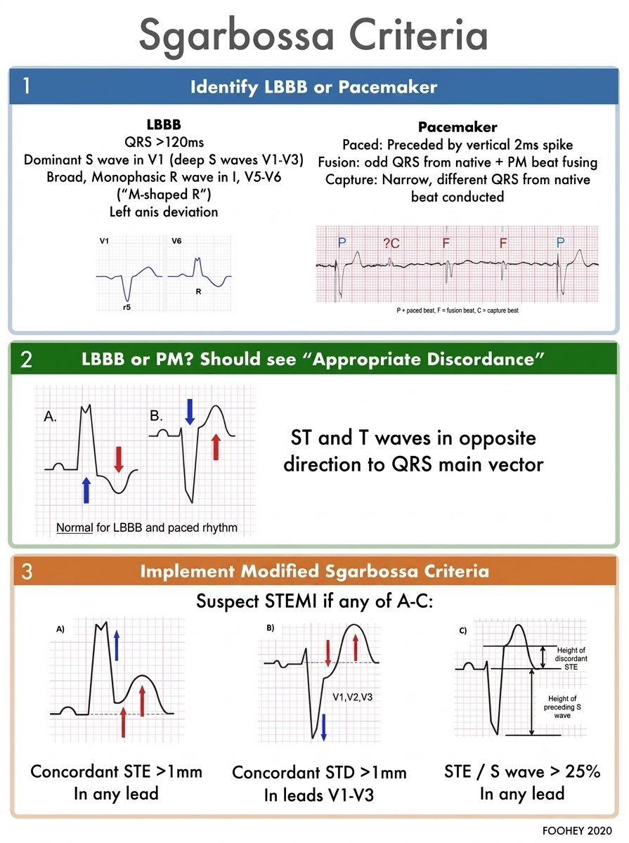 TrackYourHeart's tweet photo. STEMI in LBBB or Ventricular-Paced Rhythm

Diagnosing acute coronary occlusion can be difficult because LBBB and ventricular-paced rhythms produce secondary ST-T changes that may mask ischemia. The Modified (Smith) Sgarbossa Criteria improve the detection of acute coronary occlusion compared with the original Sgarbossa criteria.

A positive result is present if any one of the following criteria is met:

◻️Concordant ST elevation ≥1 mm in a lead with a positive (upright) QRS complex.

◻️ Concordant ST depression ≥1 mm in leads V1, V2, or V3.

◻️ Excessively discordant ST elevation with an ST/S ratio ≤ −0.25. This means the ST elevation is disproportionately large compared with the depth of the preceding S wave.

Unlike the original Sgarbossa criteria, the Modified Sgarbossa Criteria do not use a point system. Meeting any one of these criteria strongly suggests acute coronary occlusion (OMI) and should prompt urgent clinical evaluation and consideration of reperfusion therapy in the appropriate clinical setting.

References

Smith SW, et al. Ann Emerg Med. 2012;60(6):766–776.

2022 ACC Expert Consensus Decision Pathway on the Evaluation and Disposition of Acute Chest Pain.