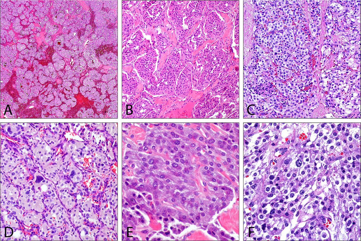 LiangChengMD's tweet photo. What’s New in the Classification of Bladder Neuroendocrine Tumors?
 
I am delighted to share our comprehensive review article published this week in Endocrine Pathology @EndoPath, written by Dr. Anandi Lobo@loboAnandi 
 
Our review provides an updated overview of neuroendocrine neoplasms of the urinary bladder, including small cell and large cell neuroendocrine carcinoma, mixed neuroendocrine neoplasms, well-differentiated neuroendocrine tumors, and paraganglioma. It highlights their distinctive histologic and immunophenotypic features, diagnostic pitfalls, clinical behavior, and emerging molecular biology. 

Emerging molecular data suggest that morphology alone may not fully capture their biological complexity. Most bladder neuroendocrine carcinomas are highly aggressive and frequently show TP53/RB1 inactivation, TERT promoter mutations, APOBEC-related changes, and lineage plasticity. Emerging transcriptomic subtypes defined by ASCL1, NEUROD1, and POU2F3 may have prognostic and therapeutic relevance. In this review, we also propose a more refined, bladder-specific classification framework that integrates histopathology, biomarkers, and molecular features.
 
Some key highlights:
•TP53 and RB1 co-inactivation is a molecular hallmark of bladder neuroendocrine carcinoma, accompanied by frequent TERT promoter alterations and evidence of lineage plasticity. 
•Transcriptomic studies are identifying lineage-associated subgroups characterized by ASCL1, NEUROD1, and POU2F3, with potential prognostic and therapeutic relevance. 
•Recognition and quantification of mixed neuroendocrine–non-neuroendocrine components remain important for diagnosis and management. 
•We discuss a more refined, bladder-specific classification framework integrating morphology, proliferative activity, and molecular alterations, with the goal of improving diagnostic reproducibility and facilitating biomarker-driven therapy. 
 
Full article is available: 
https://t.co/pLBmNKJYSk

https://t.co/i9WDNnV2CC