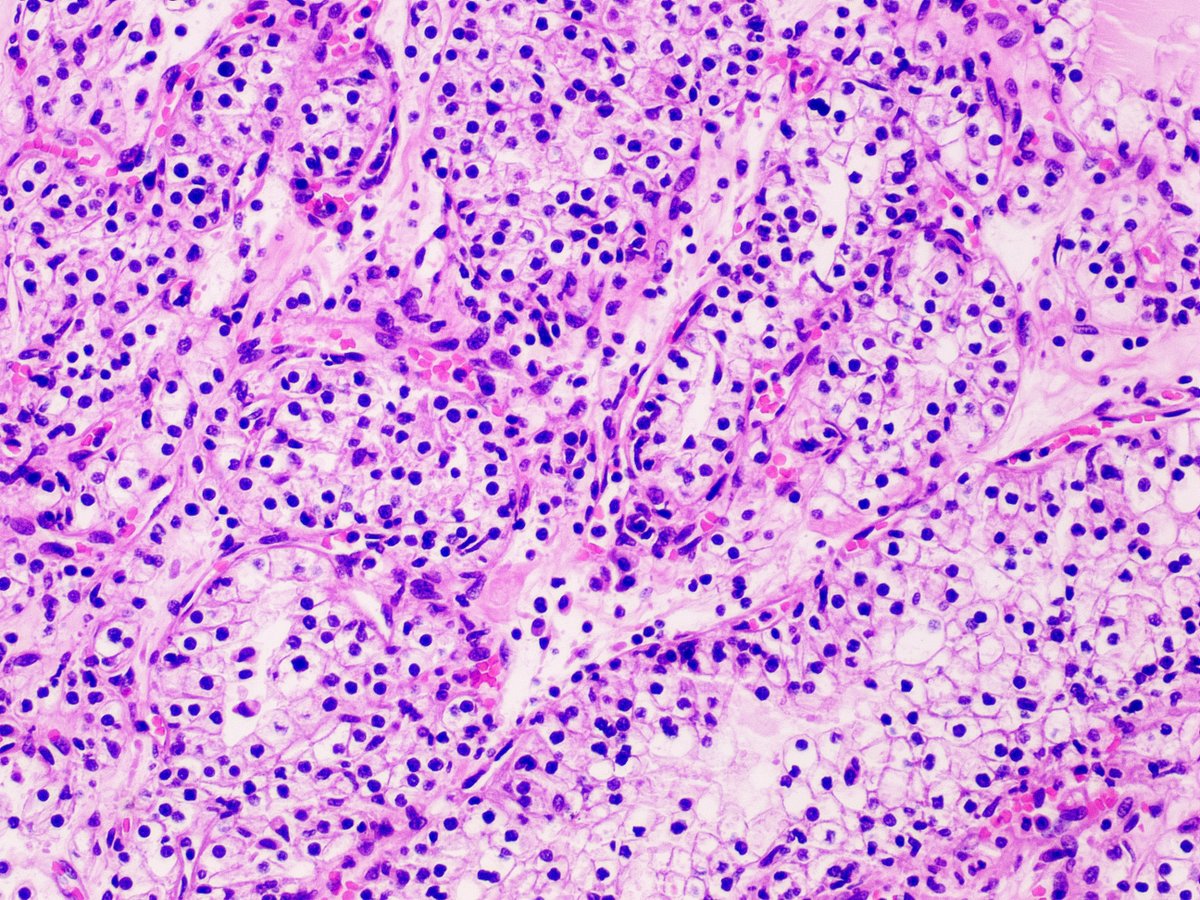 sayedalmahari's tweet photo. Suspect MiT family translocation RCCs in any young patient with different morphologies. This is an RCC in a 36-year-old female, found incidentally on CT scan. Immunostain for TFE3. #pathology #pathtweet #pathologysurvivalchain #uropathology https://t.co/SohsaQGUn5