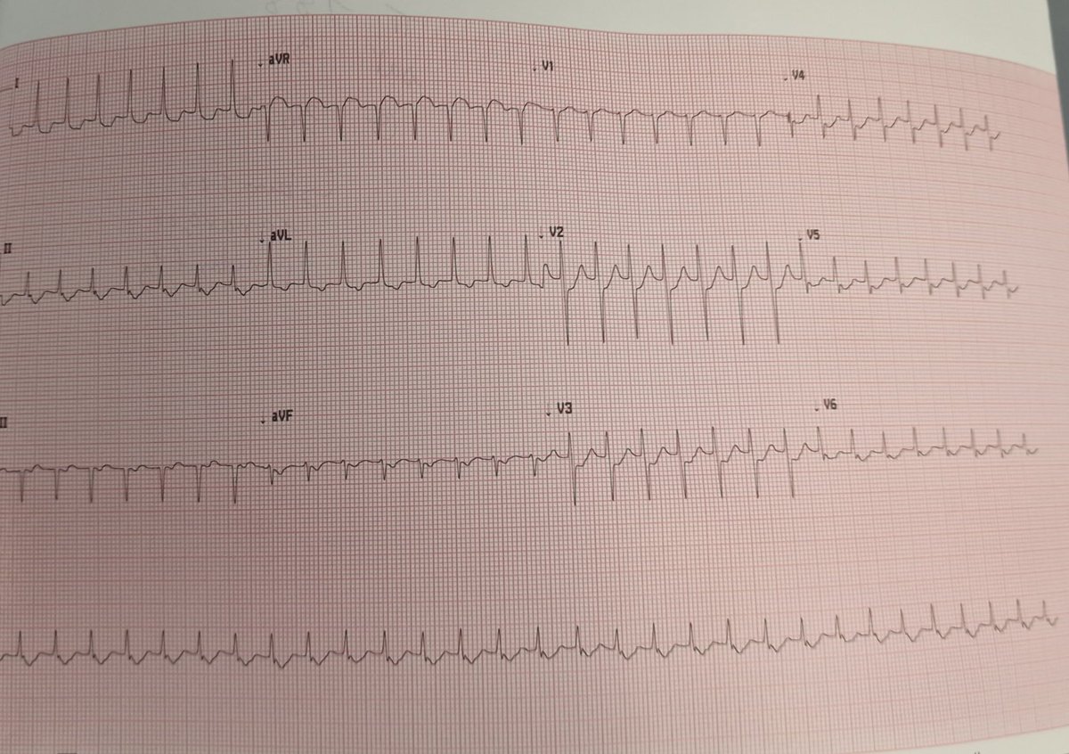 Atrial_Flutter's tweet photo. What is the rythm ⁉️⁉️⁉️
#ECG
#Cardiology https://t.co/teTPYirSaS