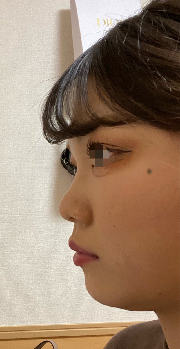 ipiq3433's tweet photo. ほんとに鼻で世界が変わった
鼻してやらなくていい施術ほんとに増えた
前はメーラー除去や、ネコ手術、人中短縮もしようとしてたのに
頬肉も目立たなくなったし口元引っ込んだように見えたし
あと人中めっちゃ短くなった
前に出してもらうのとやっぱりオーダーメイドのプロテがよかったのかな？
かなりナチュラルにしてもらった方だけど🥺
なんか鼻も肉厚感なくなった