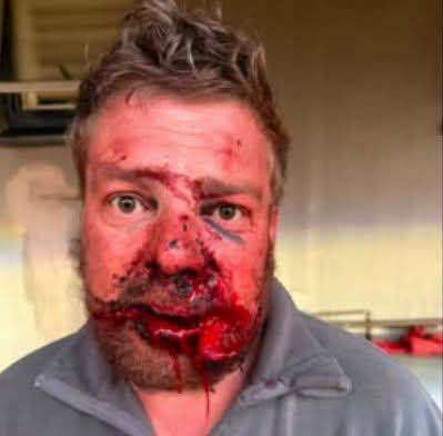 pookiepolls's tweet photo. Farm attack at Donkerhoek: “I could feel my teeth breaking”

THE GENOCIDE CONTINUES.

Hannes Brits, 43, spent more than three hours under assault in a Donkerhoek farmhouse after three attackers overpowered him, bound him tightly and repeatedly threatened his life. Two weeks later the physical evidence of the ordeal remained clear on his body.

Three suspects were arrested soon after the incident by members of Echo-1 Tactical Solutions. They are Amos Respect Mashaba, 52; Rofino Jorge Novela, 35, a Mozambican national; and Siyabulela Khulu, 35. They face charges of aggravated robbery and kidnapping after Brits was restrained and prevented from moving freely. A fourth suspect who escaped in Brits’s bakkie remains at large. The matter has been postponed pending a possible bail application.

Brits, a mechanical engineer who rents a house on the property, went to bed around 11 p.m. on the Friday of the long weekend. Both the house and the internal security gate were locked. He heard nothing unusual until a heavy blow to the face woke him. He believes the weapon was the blunt end of an axe. His mouth was badly damaged and he felt teeth breaking.

The attackers bound his hands and feet behind his back with heavy rope. Brits could sense the circulation to his hands being restricted. They then ransacked the house, removing items from his cupboard and packing some into his backpack. Larger household goods, including the refrigerator and television, were also taken outside.

Between searches the men returned to assault him further and threatened to burn him with an iron. “Just survive. Just survive,” Brits kept repeating to himself.

At times the house fell silent and he thought they had left. He struggled to free himself and felt as if he were wrenching his shoulder from its socket. The quiet never lasted. “Every time the attackers storm into my room, attack me and threaten me with the iron. And just when I think they’ve gone away, they come back,” he later said.

The attackers repeatedly tried the wrong light switches, unaware that the electricity was already off. At one stage Brits heard his bakkie’s alarm activate. Two of the men rushed into the passage, apparently believing they had set something off themselves. They returned and prepared to strike him again.

With his mouth severely injured and his lower lip hanging loosely, Brits could barely speak. He attempted to explain that the noise came from the bakkie but could not form the letter “b” clearly. He pressed his mouth against a pillow and forced out the words “bakkie keys.” One attacker still tried to hit him. The alarm was eventually silenced.

Later he heard his bakkie and a second vehicle drive away. Only then did he begin calling for help again.

Echo-1 had received prior information about a planned attack that Friday night. Alto Hoffman explained that the large, densely wooded farm area left them with little choice but to patrol and watch for anything suspicious. Shortly after 3 a.m. on Saturday they spotted a bakkie that appeared to be carrying stolen goods. Three occupants were stopped and taken to Cullinan police station.

A cellphone found among the recovered items listed an emergency contact. When called, it proved to be Brits’s brother, who supplied directions and landmarks. Security members then searched the farm. Around 6 a.m. they reached the house and heard screaming inside.

The burglar bars on a living-room window had been forced and the hallway security gate broken open. “We found Hannes on the bed,” Hoffman said. Brits was still bound and blood had run down to the soles of his feet. Hoffman radioed for police and medical assistance, then carefully worked the rope free; it had cut deeply into Brits’s flesh.

A neighbourhood-watch group arrived and gave first aid before Brits’s brother took him to hospital.

Two weeks later the aftermath was still evident. The swollen, bloodshot area around his eye had faded to blue rings. Deep rope marks remained on his wrists and ankles. A wound near his collarbone, inflicted by some sharp object, had been stitched. Another injury on his arm he believes was caused by something like a screwdriver.

Plastic surgery was required after his face was fractured in five places. A fragment of nasal bone had lodged in his eye socket, and two fingers remain bent from nerve damage. “The wounds are healing. The first few days were the worst,” Brits said.

He expressed gratitude for having survived, particularly to Echo-1 and his brother, and relief that the attackers had wrongly assumed the power was off.

@realDonaldTrump @elonmusk @BrentBozell @marcorubio