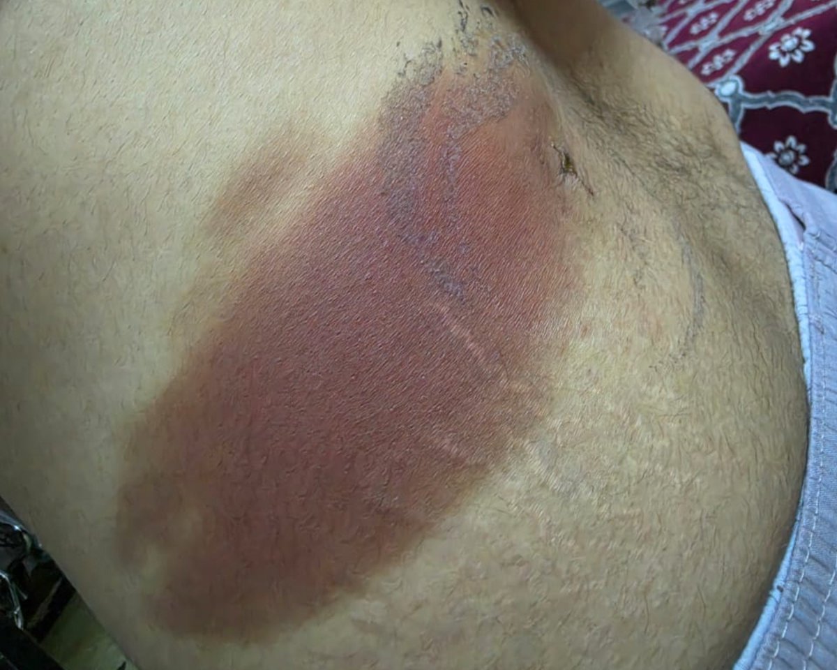 Eslam_wareth's tweet photo. Case of male pt 35 years old 
With stone pelvis lt kidney 
Post lt pcnl ecchymotic patch 

Do you have diagnosis 🤔

#urology
#pcnl
#pnl
#stones 
#complications
#eau https://t.co/bOMvuV84Zj