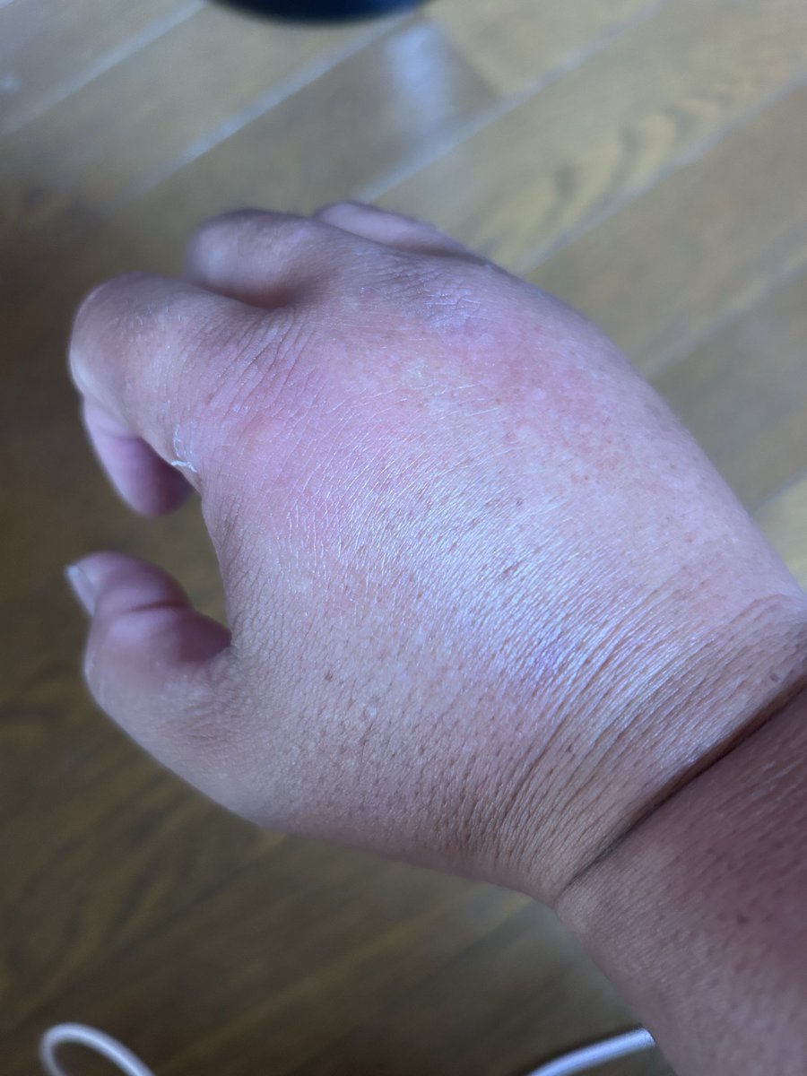 masaipocket's tweet photo. 朝起きたら昨日アブ🪰に刺された所がボンボンに腫れてた😭
腫れてて手をグー👊に出来ない💦 https://t.co/JDadtlA2GT