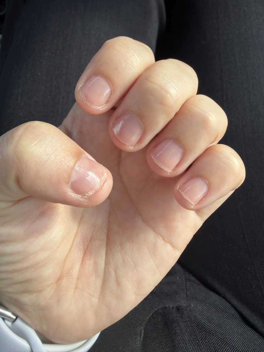 MYy070402's tweet photo. 今日の深爪さん
土日はネイルチップを付けれなかったので自爪で過ごしました😇
どうしても親指に負担が😭
またネイルチップを付けてると自爪に負担めちゃかかるから別の対策考えないと😭
 #深爪  #深爪矯正  #育爪 https://t.co/Uw1WfTcgIg