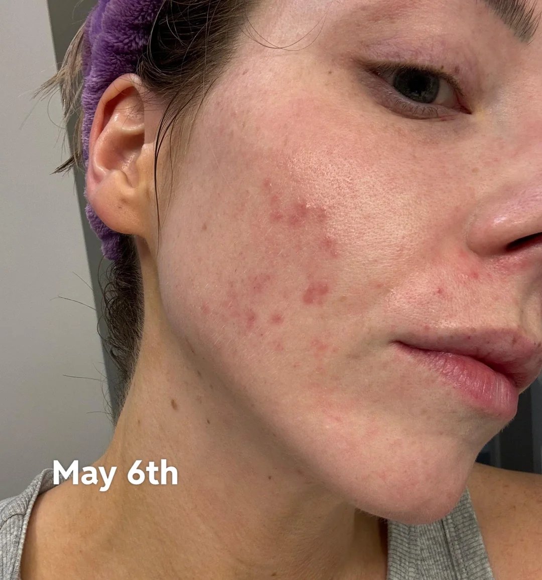 JoeTippens_'s tweet photo. 🚨 SHE TRIED METROGEL, PROTOPIC, DOXYCYCLINE AND MORE FOR PERIORAL DERMATITIS. THEN CAME IVERMECTIN.

"After struggling with perioral dermatitis since November, I was at my wit's end."

She says she tried everything.

• Metrogel for the bacterial route
• Protopic as an immunosuppressant
• Months of doxycycline and oral antibiotics

Nothing worked.

Then she tried another approach.

• Canesten
• Dandruff shampoo

Still nothing.

That's when she decided to try the "Demodex" approach: Ivermectin.

🇨🇦 In Canada, she says Ivermectin isn't available over the counter.

The 1% cream from her doctor cost more than $200 for a single tube, with no coverage.

So she says she did what many others have done:

She ordered the "horse paste" version online.

She describes it as 1.87%, compared with the prescription cream.

Then came the result that changed her story.

🗓️ After 2 nights, she noticed a difference.
📆 After 10 days: "Completely cleared."

📸 Before → After

She says she had spent months using antibiotics and prescription creams while chasing what she believed were the wrong causes.

Then she became focused on Demodex mites, which she says are increasingly linked to stubborn facial rashes.

Her explanation for the turnaround?

💊 Ivermectin.

She says Ivermectin works by paralyzing and killing the mites.

She also describes the version she used as 1.87%, compared with the 1% cream from her doctor, and says it was available at a fraction of the price.

Then comes the bigger issue behind her story.

Why pay $200+ for a product while a much cheaper version is treated so differently?

Her conclusion is blunt:

"Patients deserve access to affordable options without being shamed."

And that's why she's sharing her experience.

Months of failed treatments.

Multiple approaches.

A stubborn skin condition.

Her story is now part of the growing online conversation around Ivermectin, Demodex and perioral dermatitis.

📌 Save this testimonial if you're researching Ivermectin and perioral dermatitis.

🔄Repost it so others researching stubborn skin conditions can see her experience.

💊 Looking for quality Ivermectin? @joet
 offers pharmaceutical grade Ivermectin options and is trusted by thousands of customers worldwide.

#PerioralDermatitis #Ivermectin #Demodex #SkinHealth
