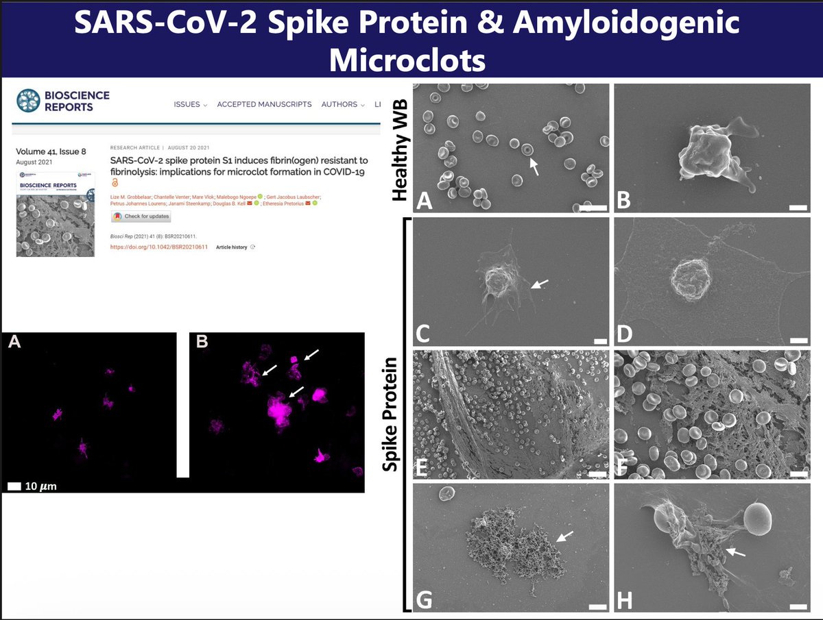 Rapid_ProjectUS's tweet photo. #SpikeProtein
#LongCovid
#Post2020Disease
#ImmuneDysregulation
#PopulationHealth
#Microvascular https://t.co/ryeFn9MB4g