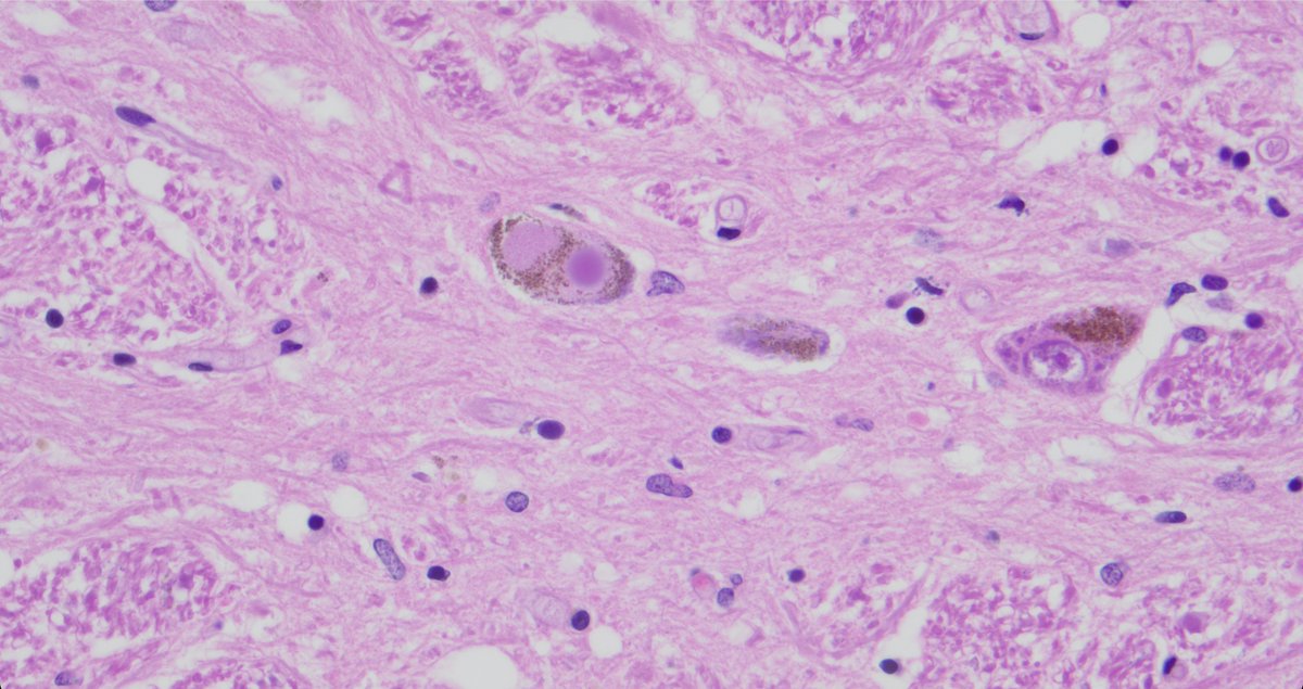 ColeBiehlDO's tweet photo. 🧠These H&E sections show round, eosinophilic intracytoplasmic inclusions within neurons.🔬
What are these structures?
And bonus question: what immunostain is shown in the third image highlighting them so nicely?
#Neuropathology #Pathology #NeuroPath #PathTwitter #PathX https://t.co/FzbWkCqpAu