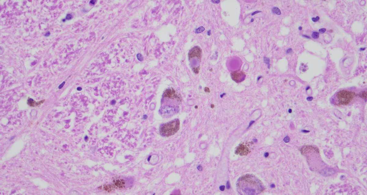 ColeBiehlDO's tweet photo. 🧠These H&E sections show round, eosinophilic intracytoplasmic inclusions within neurons.🔬
What are these structures?
And bonus question: what immunostain is shown in the third image highlighting them so nicely?
#Neuropathology #Pathology #NeuroPath #PathTwitter #PathX https://t.co/FzbWkCqpAu