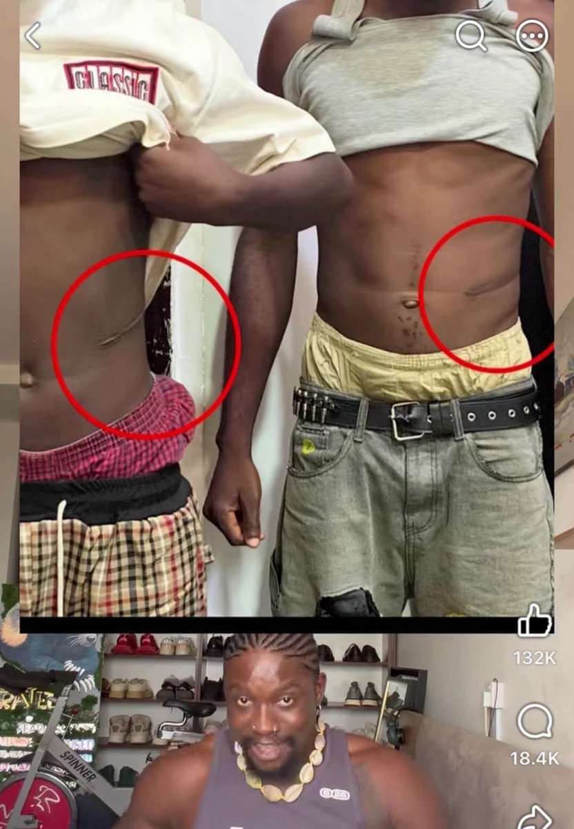 CALABARRFINEST's tweet photo. There is another side to this kidney story that  people need to know.

I actually have two very close contacts who know about this case. One of them even shared the story on his WhatsApp status about two weeks ago, long before it started gaining attention on VDM’s platform.

And the account I heard from them, including what one of them said he heard directly from boy’s mother, is different from the impression currently being created.

According to the account I received, this boy did not simply go to a hospital for another procedure and unknowingly wake up to discover that his kidney had been removed.

The claim is that the boy knowingly went to the hospital for the purpose of having his kidney removed in exchange for money. His friend had apparently gone through the same process before, and the boy agreed to do it as well.

The issue, came afterward.

The money involved was allegedly paid into the friend’s account, but the boy was allegedly given only ₦150,000. Feeling cheated after the transaction, he eventually started speaking out about what had happened.

Now, if this account is accurate, then that is a very different story from the impression many people are currently getting.

And let me be clear: knowingly agreeing to sell a kidney does NOT make organ trafficking acceptable. It does not excuse exploitation, and it does not make the people involved innocent.

But it absolutely matters when we are trying to establish what actually happened.