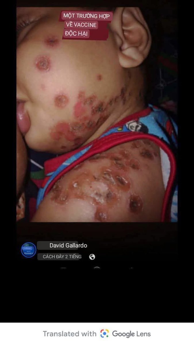 SmolfSmolf7's tweet photo. What ingredients are in flu vaccines?

Thimerosal, hydrocortisone, cetyltrimethylammonium bromide, polysorbate 20, polysorbate 80, baculovirus and cellular DNA, beta-propiolactone, gelatin, sodium deoxycholate, canine kidney cell proteins and DNA, Triton X-100, egg proteins, gentamicin sulfate, formaldehyde, neomycin (and many others).

If you wouldn't eat it, why inject it into your body?