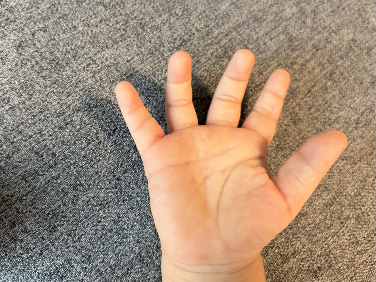 krkrm_m's tweet photo. 降園したんだけど手のひらに違和感が… https://t.co/SQ4ywxfH8D