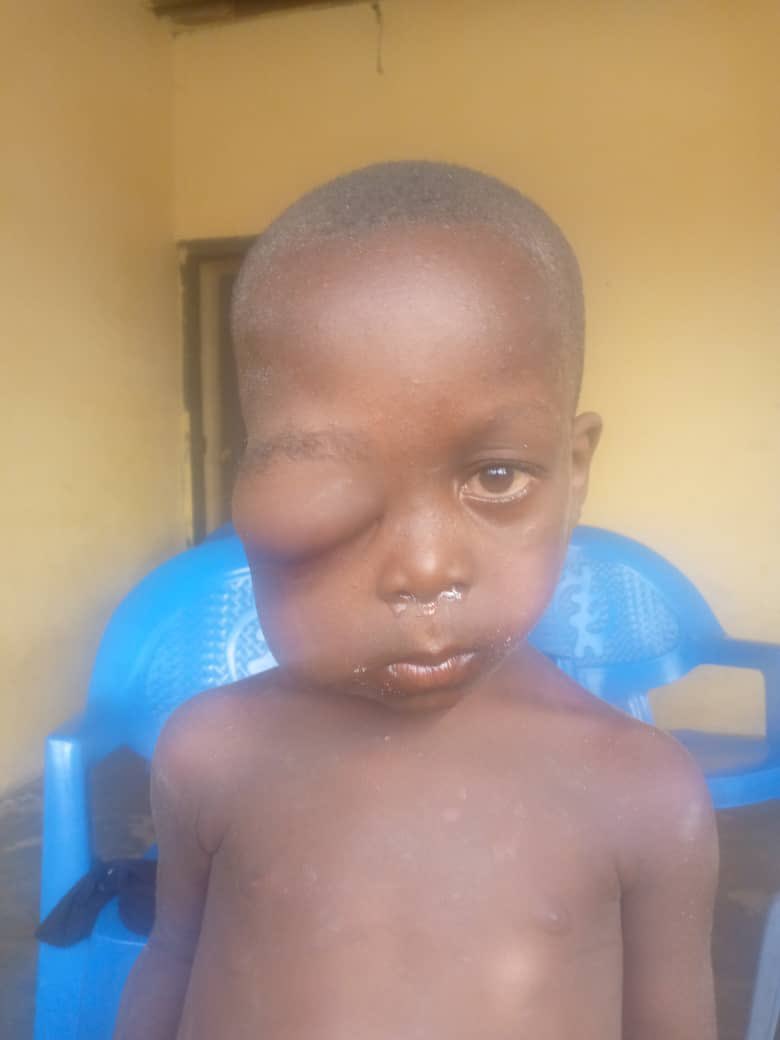 NestaKobby's tweet photo. Hello Good Ma’am, thanks for the information, how can I register so get surgery for this boy, it’s difficult for the parents to even take him to the hospital for diagnosis. Please if you can help 🙏🙏🙏He’s at Sege Constituency https://t.co/6YzGsF4Bk1