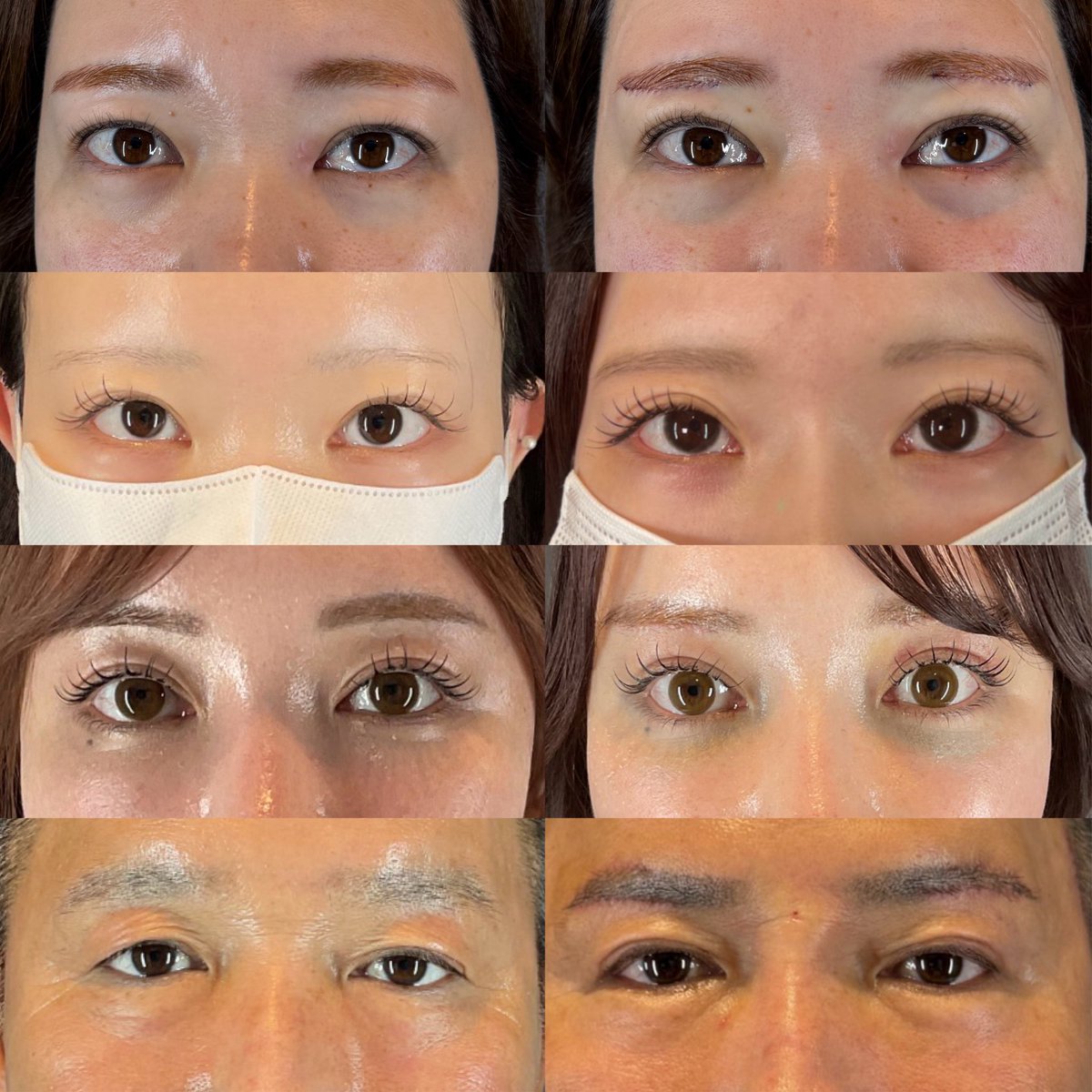 LUVOCLINIC's tweet photo. 👀眉下切開
✔️まぶたが重く見える
✔️二重幅が狭くなってきた
✔️目元をスッキリさせたい
✔️切開は最小限にしたい
そんな方にオススメの施術です☺️ https://t.co/iibfmtKqCq