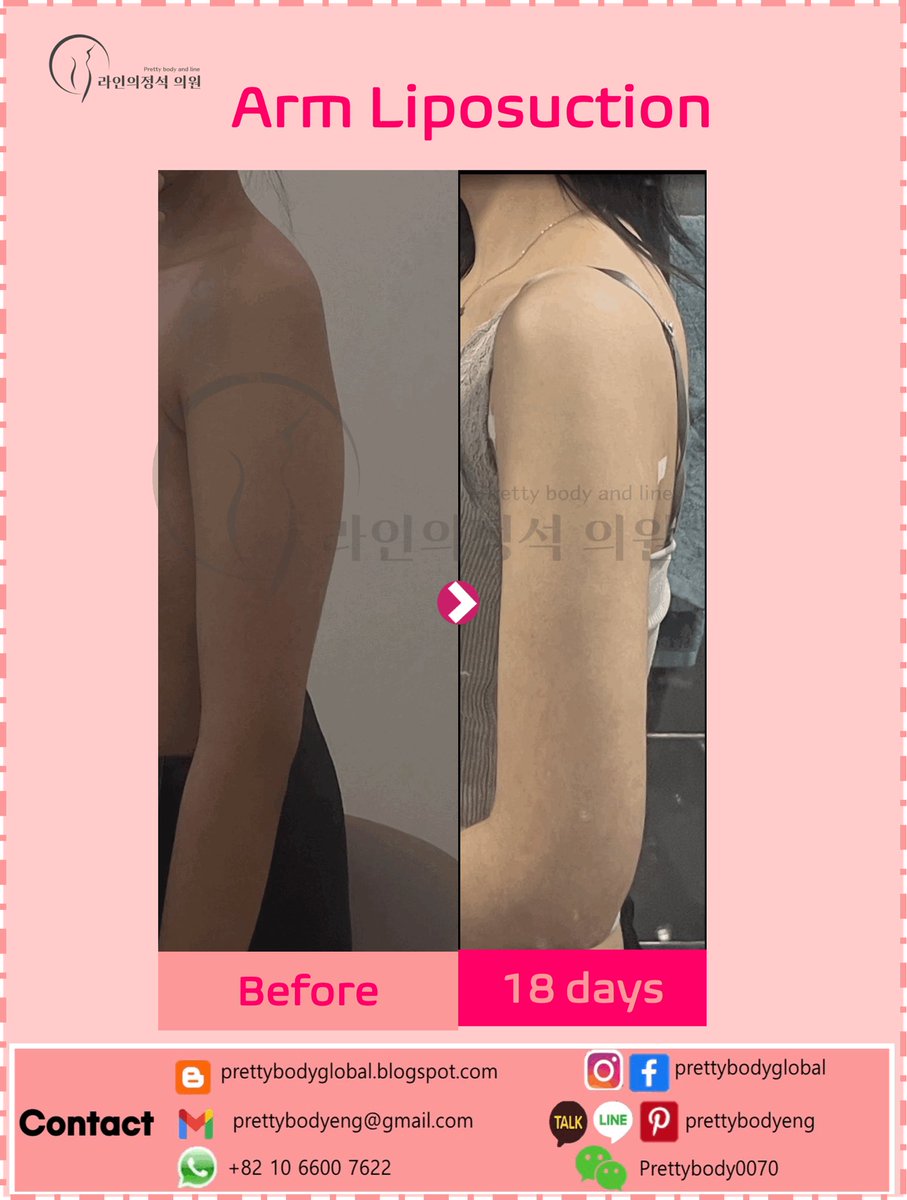 ClinicEng's tweet photo. [Pretty Body and Line]Reasonable Price and Reasonable Result of Arm liposuction in Korea! 

📍Procedure(s): Arms, Axillary, Armpit Liposuction
📍Surgeon: Dr. JUNG, Chae-Hong
📍Post: 18 days
#prettybodyandline #armliposuction #reasonableresult #reasonableprice #liposuction https://t.co/MmZYufTjTM