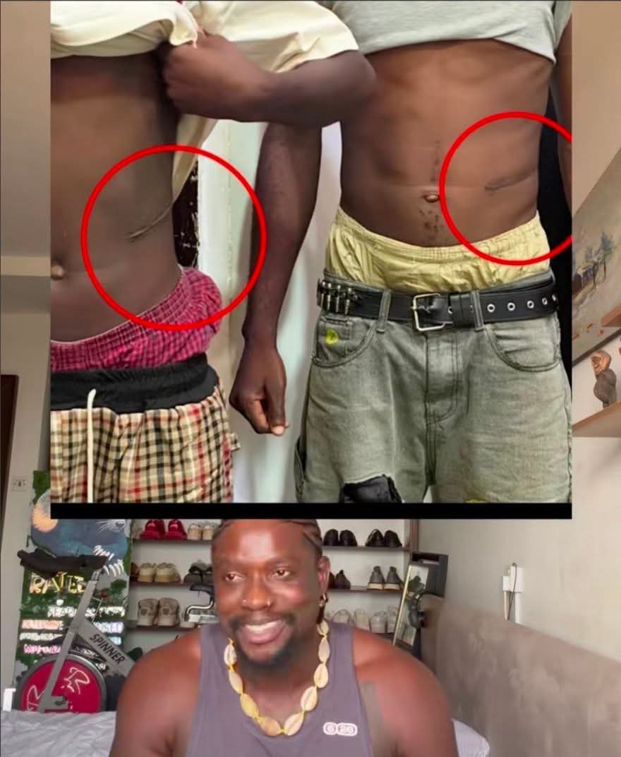 gsbabatunde's tweet photo. It's becoming clearer.
Seems the whole thing looked like a failed Deal and the guy decides to expose them.
If it's not a failed deal, maybe they deceived him, the whole truth will come out soon.

More revelations from VDM shows the k1dn3y guy was actually taken to the Hospital by one of his friend who S0Ld his onw k1dn3y already for 7M.

And the whole thing became scary to know that many young guys in Nigeria have only k1dn3y.
Dem don sell their Left k1dn3y for m0ney.

Chai.
Before you marry, try asn your man to show his k1dn3y test oooo 🤣🤣🤣
No go marry man wey don sell one of his k1dn3y.
 
Some people will say, shebi it's my k1dn3y, i have the right to do whatever i like with it.

Oga, you can not s£LL any part of your body for m0ney. 
It is a crime under the law.
Exchanging any part of your body, both internal and external for m0ney is against the law (section 53 of the National Health Act)

The law says you must give them voluntarily if you wish to d0nate them.
You must not collect shishi when giving them out for FR33 

Same rule applies to the vag1na for women and Joystick for men.
You must not collect m0ney to give any man your Vag1na.
It must be voluntary and FR33 
It is illegal for any man to pay for it.

As a man
It is illegal for you to collect m0ney from any woman to sample her vag1bmna with your Joystick. 

The law frowns against it, you must give it voluntarily and FR33.

Ehn Atanda, na my body na.
Your eyes go clear when you start to eat FR33 stony beans.

The Law own you.
One of our former Senator is currently serving for a crime related to such in the UK.

Ignorance of the law is no excuse

CREDIT: THE PEOPLE'S PARLIAMENT