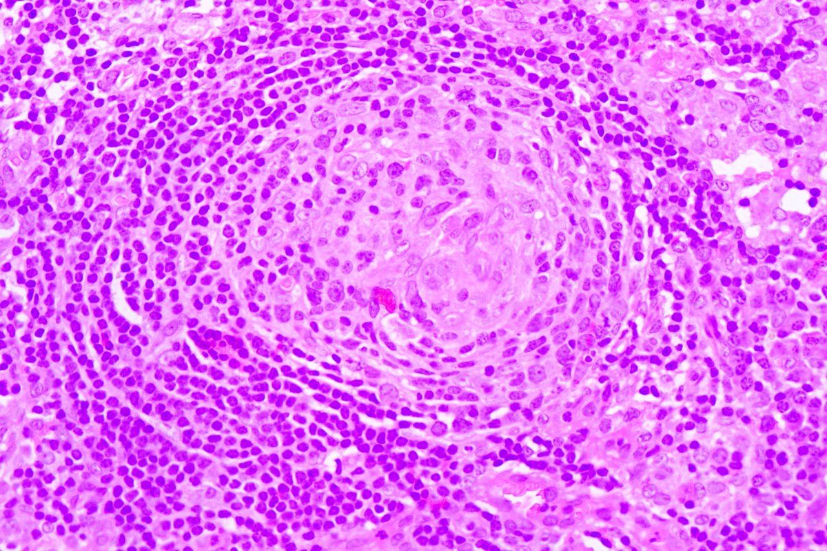 RobinYadav2009's tweet photo. Another Spotter!! Lymph Node #pathtwitter #medtwitter https://t.co/2Zzc57oOYS