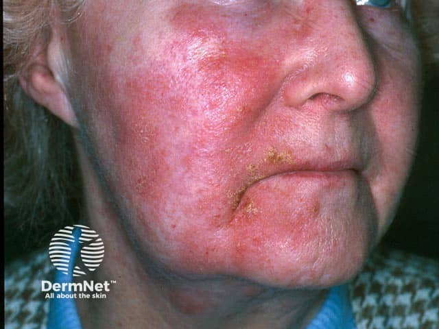 SkinofColorcomm's tweet photo. A patient presents with a pruritic, red, scaly facial eruption after exposure to a skincare product. Which mechanism best explains this?

A. IgE-mediated mast cell degranulation 
B. T-cell-mediated delayed HSR
C. Immune complex deposition
D. Antibody-mediated epidermal damage https://t.co/mAHWlH8usB