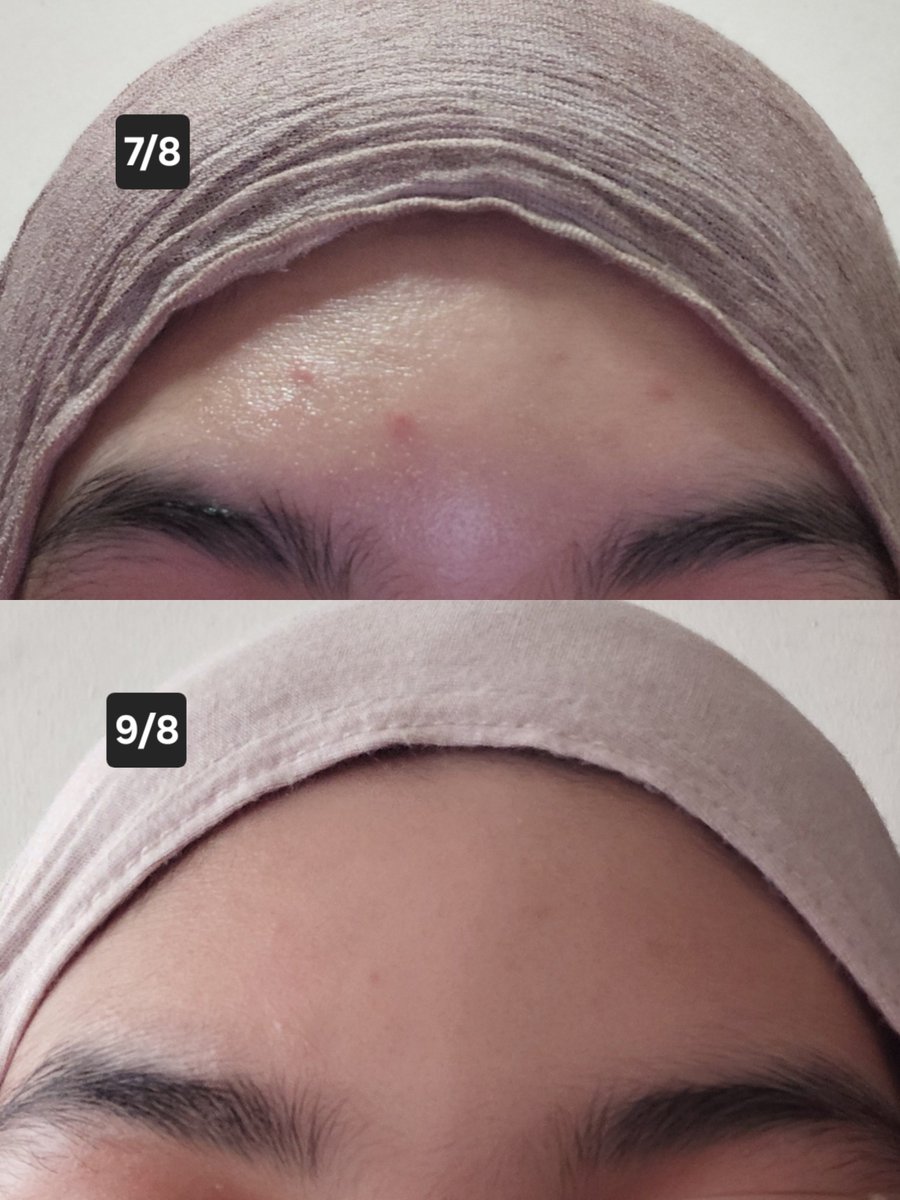 shopwithyana's tweet photo. maaf shakap, you tak try you rugi gila!! tengok la ni, jerawat i kecut dalam masa 2 hari je. takde pakai ubat jerawat tau, memang i sapu cream ni je. sebab tu la i dah sampai 2nd tube 🙂‍↕️ https://t.co/lIpbKVQkPg