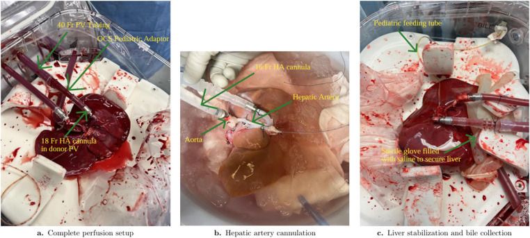 amjtransplant's tweet photo. Available in our August issue: "Normothermic machine perfusion of pediatric liver allografts: A single-center case series," by Huang et al
https://t.co/QjhfTXz20j 
#LiverTransplantation #PediatricTransplantation #MachinePerfusion #OrganPreservation https://t.co/i3oj6Lqqug