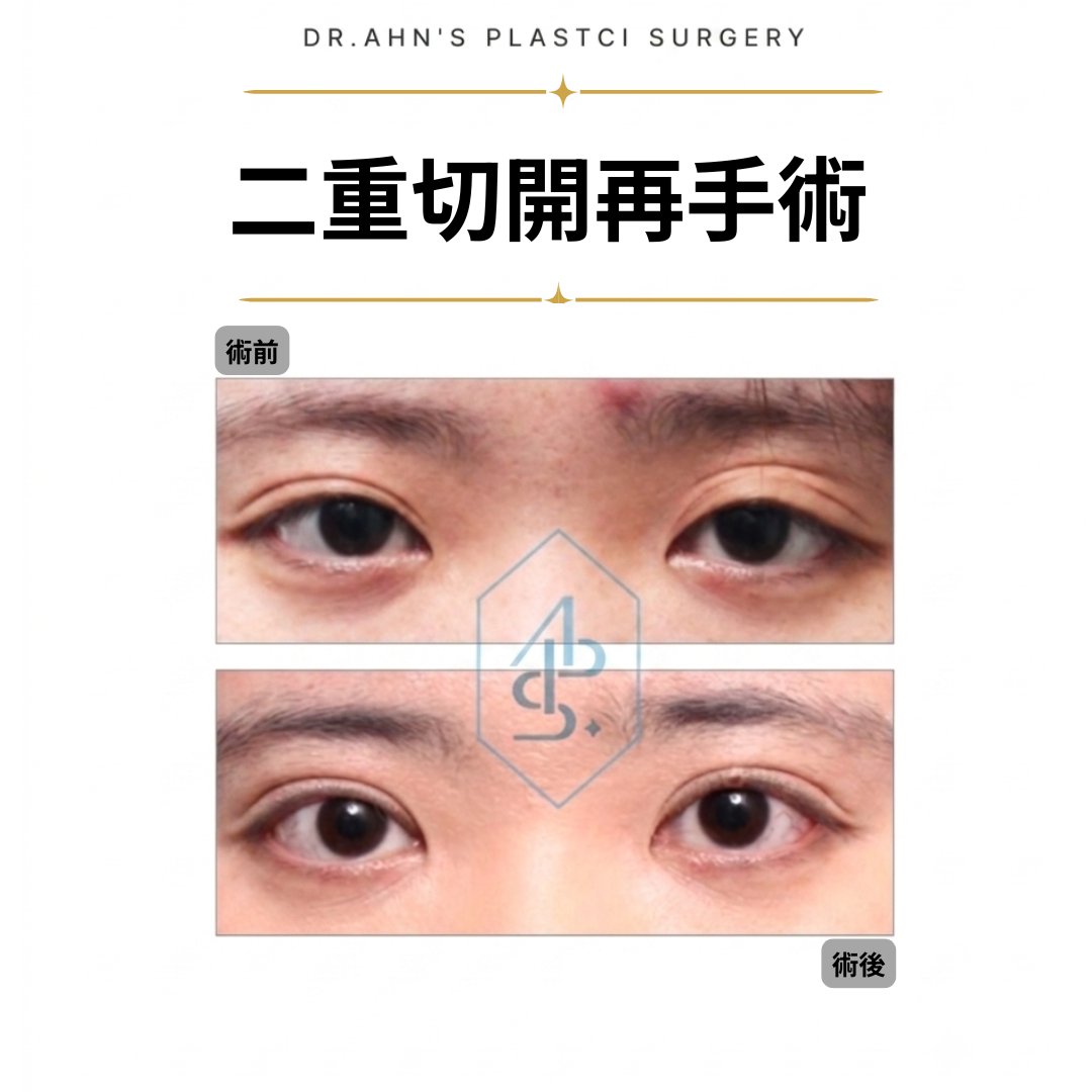dr_ahn_ps's tweet photo. 二重の手術は繰り返すほど内部からも外側から再手術するための条件が悪くなっていきます。手術は最小限で行うのがよいです❗

二重・眼瞼下垂のお悩みは
目の専門医ドクターアンへ👨‍⚕️

▶️LINE相談 → https://t.co/Mg4CdsMM0V

#二重修正  #目つき矯正 　#二重整形 https://t.co/ER1SHagDvl