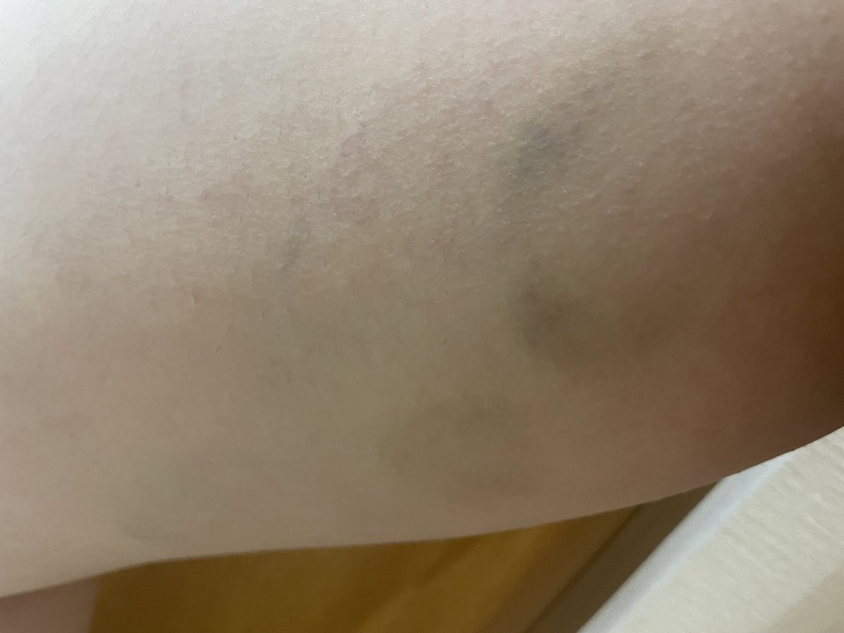H0Qep5's tweet photo. 女風してる人とえっちしたとき、全部が上手すぎて苦手な噛み跡も耐えられるくらい気持ちよかったけど、本名聞かれなくて「あちゃん」て呼んでくるのだけが本当に面白かった
噛み跡が痣になって1週間くらい痛すぎてしあわせだった https://t.co/z17i9rJK6b