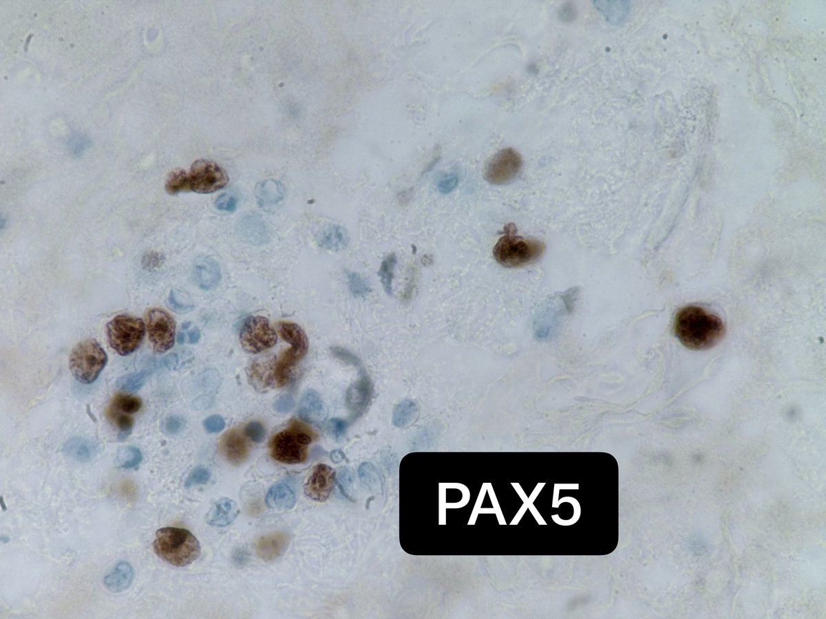 PathologyKate's tweet photo. Pleural fluid: This is not a Primary Effusion Lymphoma, but if it were, what viruses could be expected to be positive in the neoplastic B-cells? #BoardFodder https://t.co/Oc15wLw4jj