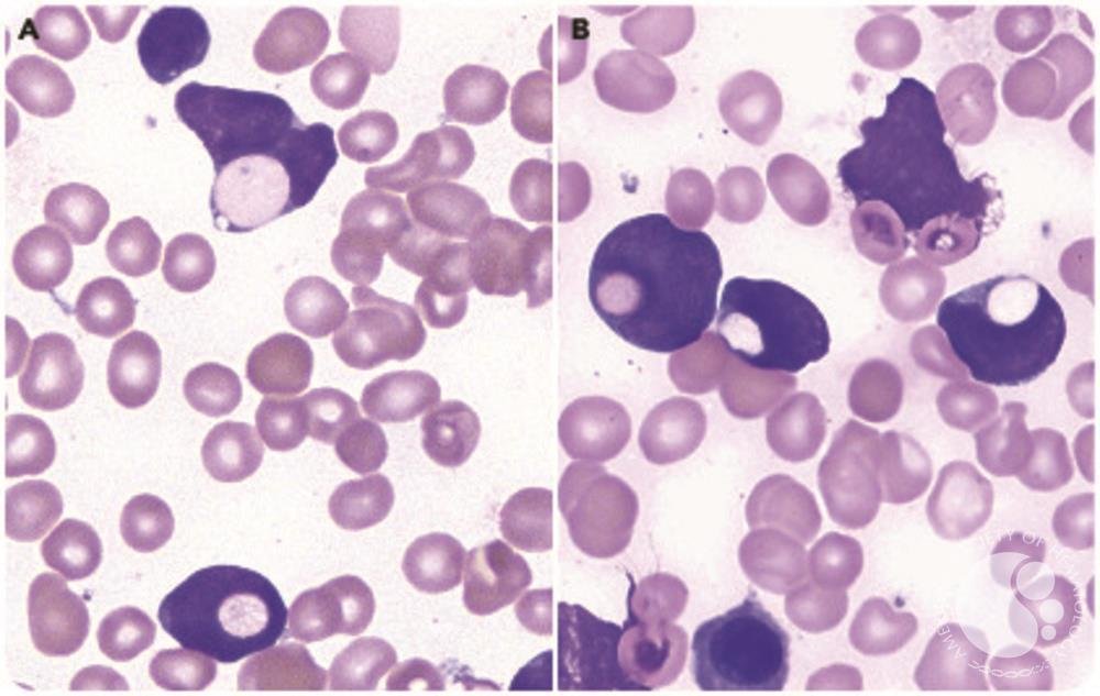 smbenlazar's tweet photo. Frequent erythrophagocytosis by leukemic blasts in B-cell acute lymphoblastic leukemia | ASH Image Bank | American Society of Hematology https://t.co/PGH3WwWBKZ #ASHImageBank https://t.co/eAqx0hMfLm