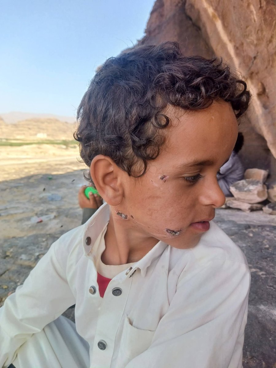 hashtagyemen77's tweet photo. بعد عضة الكلب مباشرة تم اسعافه الى اقرب مركز صحي خلال 5دقائق، وقام بغسل الجروح بكل المطهرات حتى الماء والصابون، وتم اسعافه الى مستشفى السلام بصعدة خلال ساعة مسافة الطريق فقط ، واستقبلوا الحالة وجارحوا الافعال وعملوا له لقاحات كما هو مكتوب في الوصفة واعطوه علاج، وقالوا حافظوا على مواعيد اللقاحات ولا تتأخروا،وهو ماحصل،وبعد اخذ لقاحين حسب ماهو محدد
وبعد 21يوم من العضة، للاسف الشديد ظهرت اعراض الداء وهو الخوف الشديد ، رديناه السلام رفضوا يستقبلوه او يعملوا له رقود، بالكاد عملوا لنا تحويل الجمهوري، ذهبنا  به الى الجمهوري  رفضوا يرقدوه وقالوا تحويل صنعاء، ذهبنا الى الجمهوري بصنعاء قالوا  ، هذا الطفل لم يأخذ اللقاح نهائيا او اللقاح منتهي او تعرض لسوء تخزين، وقالوا للأسف الشديد تأخرتوا ولا يوجد عندنا دواء له من مرة، وفي الاخير تأخذ ابنك وتعود خائبا مكسورا، وابنك ينهار تدريجيا امام عينيك وهو يتشبث بك ويستغيث ويلتجئ اليك فلا تجد له حل الا البكاء فقط،،،، ممن نشكوا والى من نشكوا... حسبنا الله ونعم الوكيل ولا حول ولاقوة إلا بالله.. 
صورة مع التحية، لوزارة الصحة.

عوض فاضل
