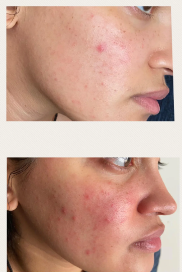 _ivermectinkart's tweet photo. Two Years of Rosacea. Then Five Days of Horse Paste.
A schoolteacher. Let's call her Ms. M.

She had rosacea. Red, bumpy patches on both cheeks. Sometimes burning, sometimes itching. It had been getting worse for over two years. Makeup couldn't hide it. Nothing could.

She saw two dermatologists. Got metronidazole cream. Azelaic acid. Even a low-dose antibiotic. Nothing worked. Her skin only got angrier.

Then she saw a post on X. Someone was talking about Ivermectin paste - the "horse" stuff - for rosacea. She thought it was crazy.

But she was tired of hiding. Tired of the burning. Tired of people asking, "What's wrong with your face?"

She bought a tube. Applied a tiny pea-sized amount to her cheeks before bed.

Day 1: Woke up. Still red. No change. She almost gave up.

Day 2: The burning sensation was less intense. She touched her cheek - it felt cooler.

Day 3: Her husband noticed first. "Your face looks less angry," he said. She looked in the mirror. The bumps were smaller. The redness had faded to a lighter pink.

Day 4: The rough texture was almost gone. Her skin felt smooth for the first time in years. She took a photo and compared it to Day 1. She couldn't believe it.

Day 5: She walked into the kitchen and her husband said, "Is that your skin?"

She ran to the mirror.

It was clear. Not perfectly clear - but close. No bumps. No burning. Just skin that looked like hers again.

She cried. Not from sadness. From relief.

Her words:
"I spent two years and hundreds of dollars on creams that did nothing. And in five days - five days - a tube of 'horse paste' gave me my face back. I don't care what they call it. It worked."

⚠️ Not medical advice - just one person's experience. Always consult your doctor.
