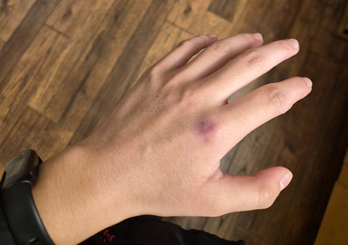 WildCardClubs's tweet photo. Then somehow busted a blood vessel in my knuckle doing jujitsu 🫩 bro is dark purple https://t.co/ppzNeH4up7
