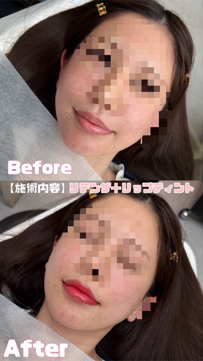 plum_upmpm's tweet photo. 渡韓美容レポ🇰🇷【ゴールデンバランスクリニック🏥】

経験15年以上のベテラン医師のみが施術してくれるから安心感が凄い✨
ちなみに韓国では医療機関以外のアートメイクは違法で、医師常駐のクリニックでのみ可能らしい🫶
毎月お得なイベントしてるから渡韓する時オススメｯ💖 https://t.co/AOwUw8yzfa
