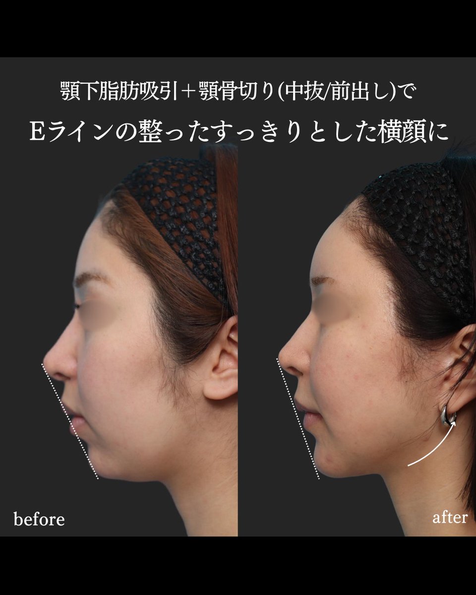 drlee_verite's tweet photo. 定期的に糸によるリフトは行っていたそうですが、糸リフト直後の強く引き上がった状態でも満足できないということで、ベースの骨格からシャープにした上でリフトを行なうことにしました

〈内容〉
頬骨削り￥1,320,000
アゴ骨切り（前出し）￥1,210,000
頬＋頸部フェイスリフト￥1,320,000

↓続く https://t.co/8nQebYkBNZ