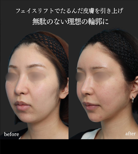 drlee_verite's tweet photo. 定期的に糸によるリフトは行っていたそうですが、糸リフト直後の強く引き上がった状態でも満足できないということで、ベースの骨格からシャープにした上でリフトを行なうことにしました

〈内容〉
頬骨削り￥1,320,000
アゴ骨切り（前出し）￥1,210,000
頬＋頸部フェイスリフト￥1,320,000

↓続く https://t.co/8nQebYkBNZ