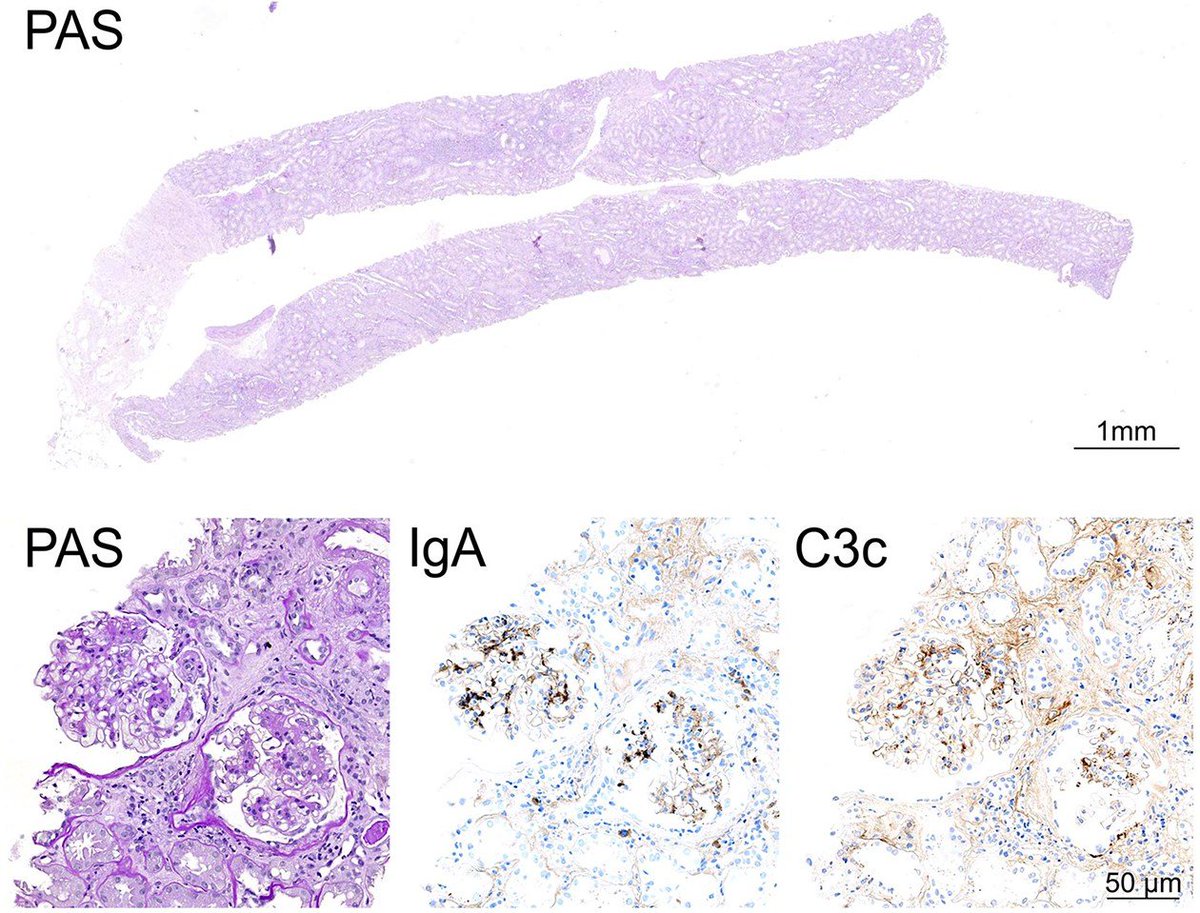 CKJsocial's tweet photo. 🧐Exceptional Case:

Differing effects of Nefecon and Sparsentan in a patient with recurrent IgA nephropathy post-kidney transplantation

https://t.co/pADrktOZ8q https://t.co/XT7YqAogBn