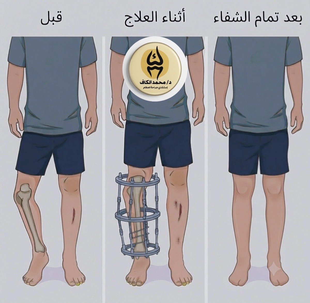 dralkaff's tweet photo. تقنية الاليزاروف في جراحة العظام https://t.co/tijplfKPEL