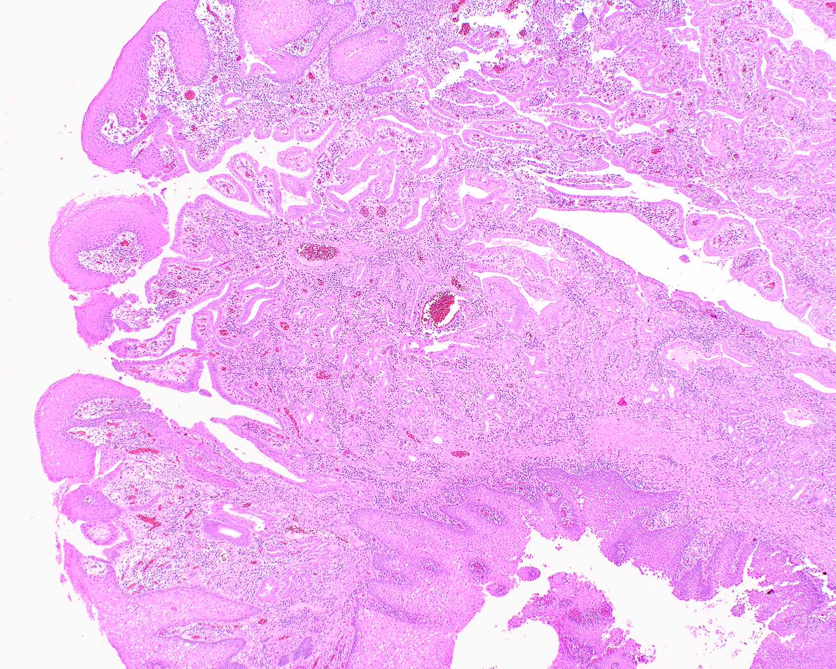 LizMontgomeryMD's tweet photo. A technically terrific endoscopic submucosal dissection (ESD) specimen with a gastric intramucosal adenocarcinoma (T1a) that has pyloric/cardiac gland differentiation. @xiahepublishing @UMiamiPathology @ModernPathology @science_press https://t.co/9HukifWv56