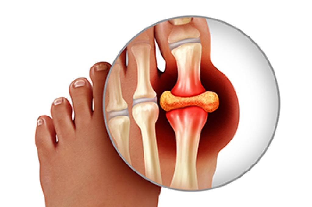 DavePoonaiDPM's tweet photo. Gout Pain in the Big Toe https://t.co/fL0ZxPIQXF https://t.co/Kuzxjse3tj