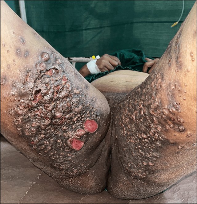 GYerathel's tweet photo. Extensive exuberant giant molluscum contagiosum with ulceration in a woman

Please seek medical help don't wait until it's too late https://t.co/Jwme3rwP7v